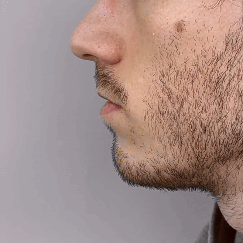Rhinitis Láser Nasal